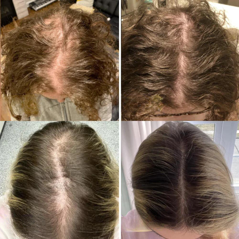 RevitaCrown | Ignite Your Scalp’s Power for Thick, Head-Turning Hair | ribuella