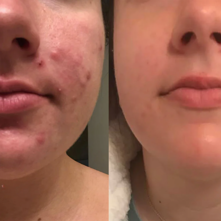 Silicone Scar Sheets for Skin Repair | ribuella