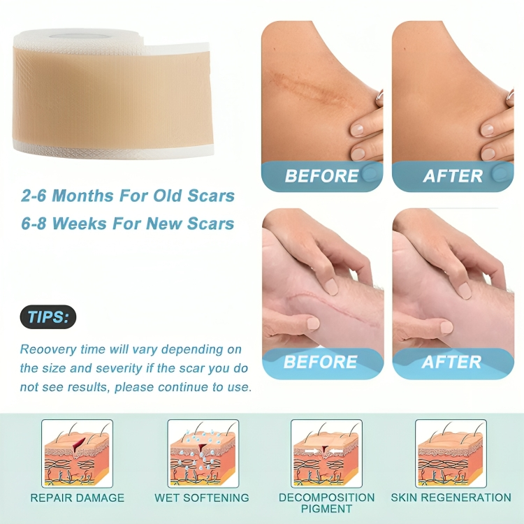 Silicone Scar Sheets for Skin Repair | ribuella