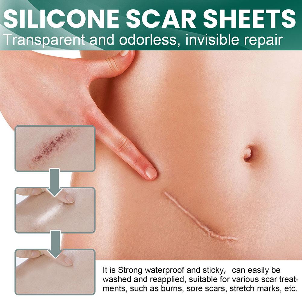 Silicone Scar Sheets for Skin Repair | ribuella