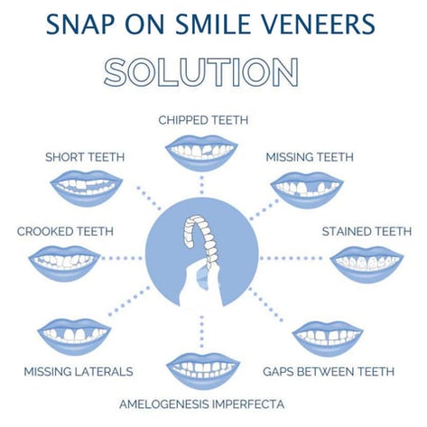 Temporary Snap On Dental Veneers - Upper Lower Cosmetic Tooth Cover Set