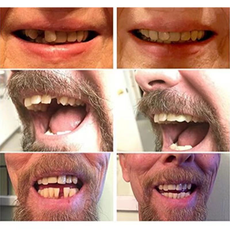 Temporary Cosmetic False Teeth Veneers — Natural Look, Secure Fit