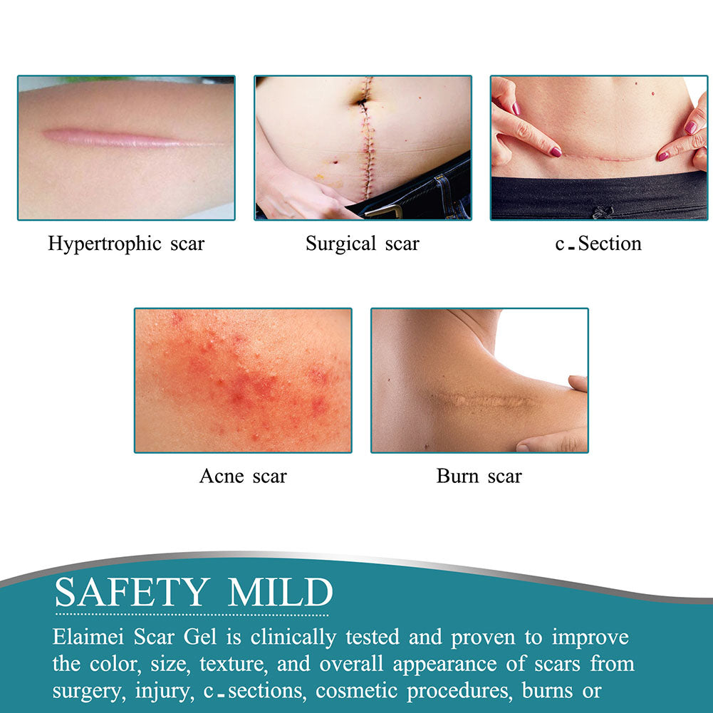 Silicone Scar Tape Roll — Nearly Invisible Skin-Smoothing Sheets